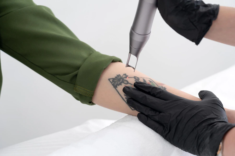 Czy można ponownie wykonać tatuaż w miejscu laserowego usuwania tatuażu?
