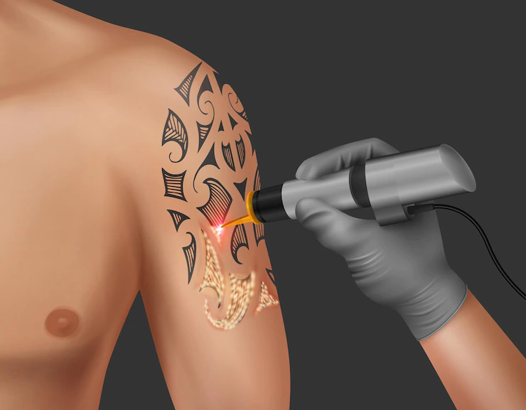 Laserowe usuwanie tatuażu - czy są jakieś skutki uboczne?